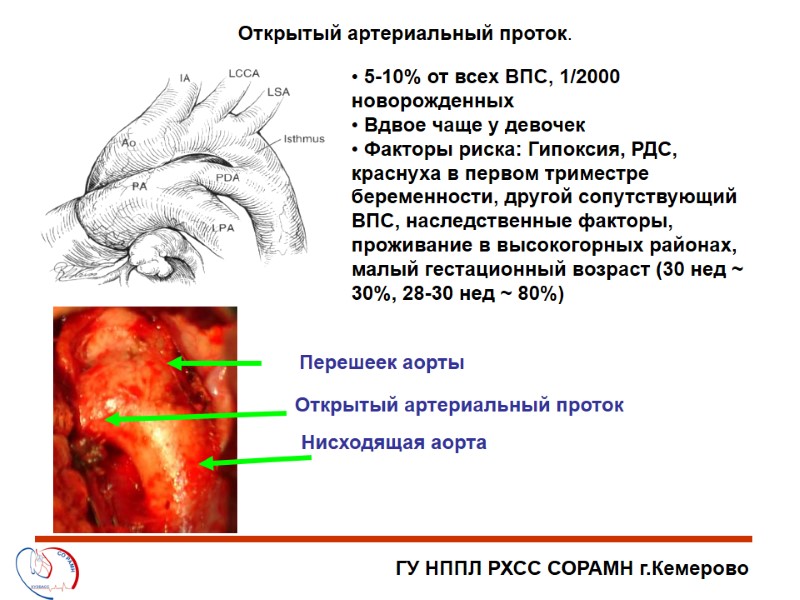 ГУ НППЛ РХСС СОРАМН г.Кемерово Открытый артериальный проток.  5-10% от всех ВПС, 1/2000